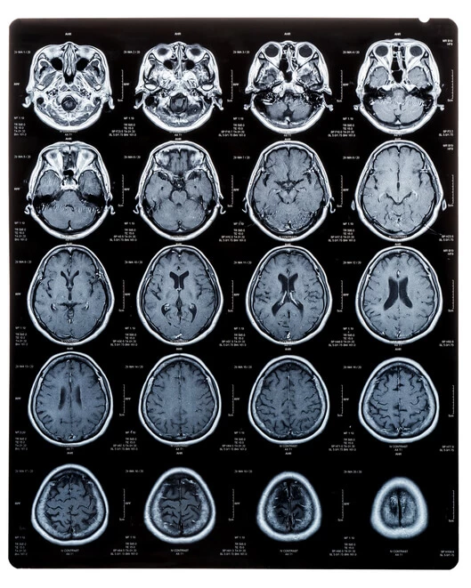 mri images of the brain